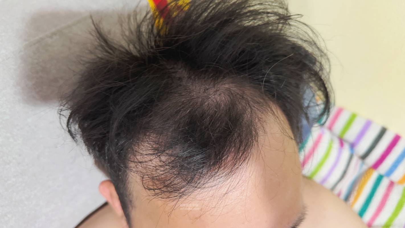 髮量危機有救了？愛爾麗診所 拉髮密雷射 台北頭皮雷射心得公開 養髮醫美體驗分享