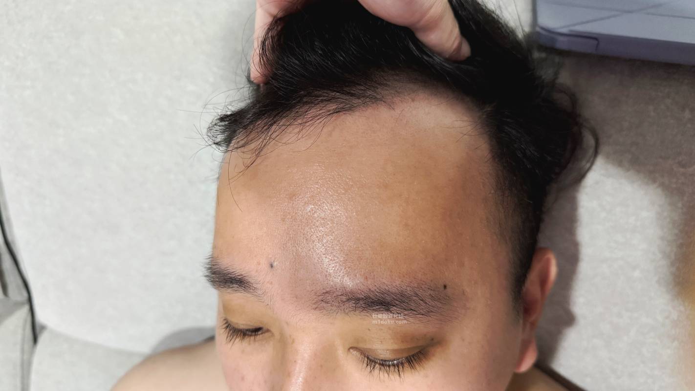 髮量危機有救了？愛爾麗診所 拉髮密雷射 台北頭皮雷射心得公開 養髮醫美體驗分享