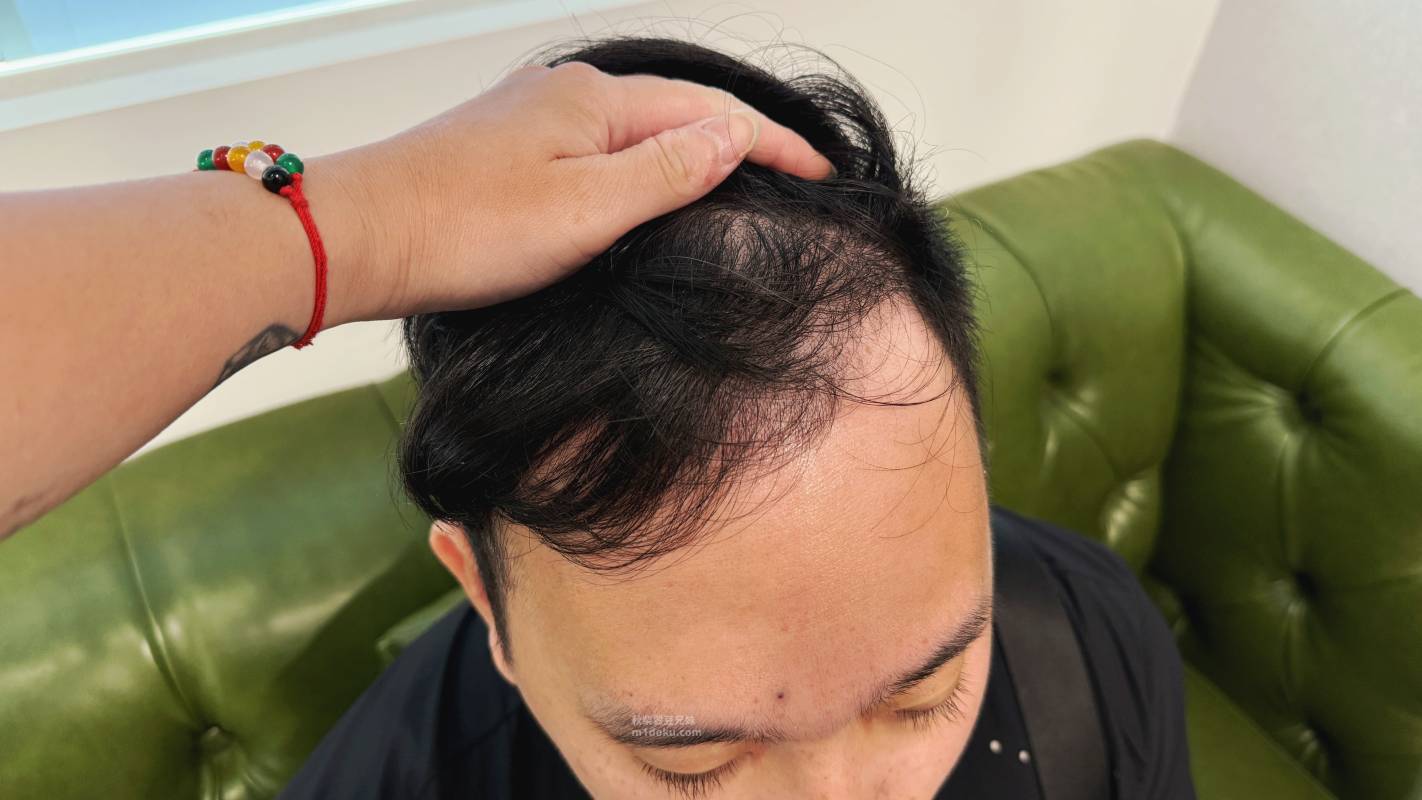 髮量危機有救了？愛爾麗診所 拉髮密雷射 台北頭皮雷射心得公開 養髮醫美體驗分享